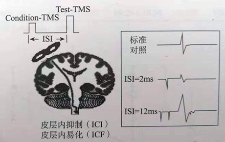 科普丨前途无量的TMS新模式——单拍成对脉冲刺激（pTMS）