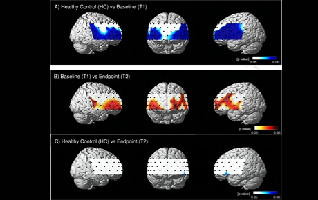 精神疾病治疗后，如何客观评估疗效？